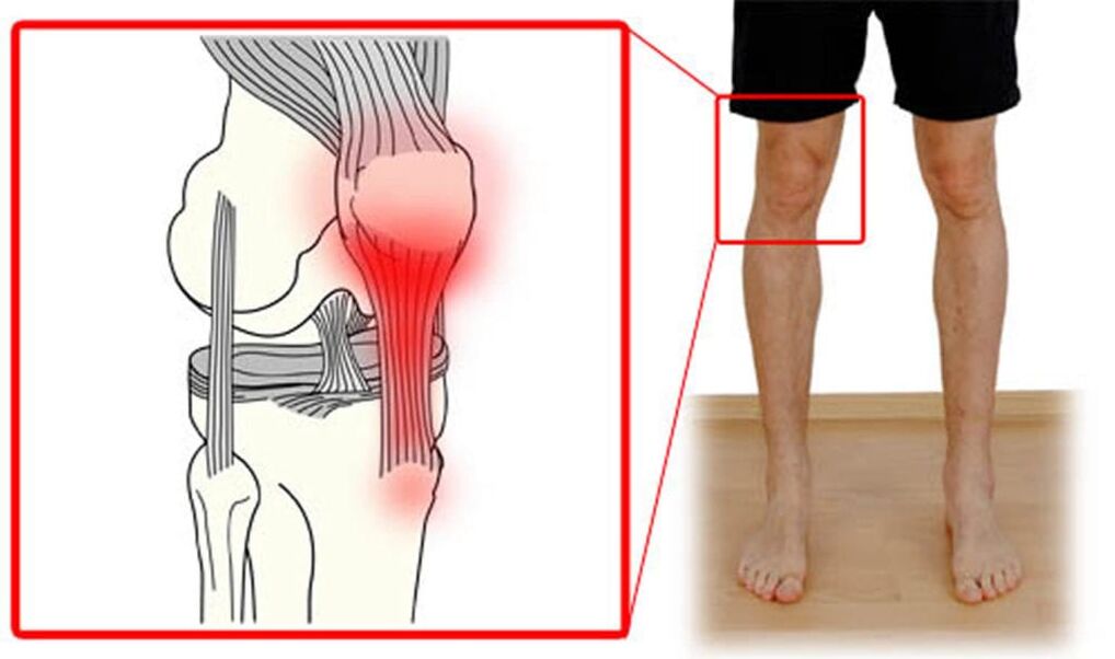 Tendinite – Infiammazione dei tendini dell'articolazione del ginocchio