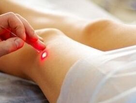 Trattamento dell'artrosi dell'articolazione del ginocchio con un laser